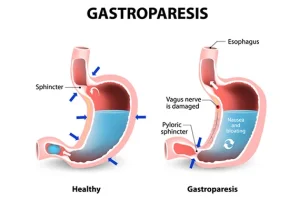 gastroparesis adalah